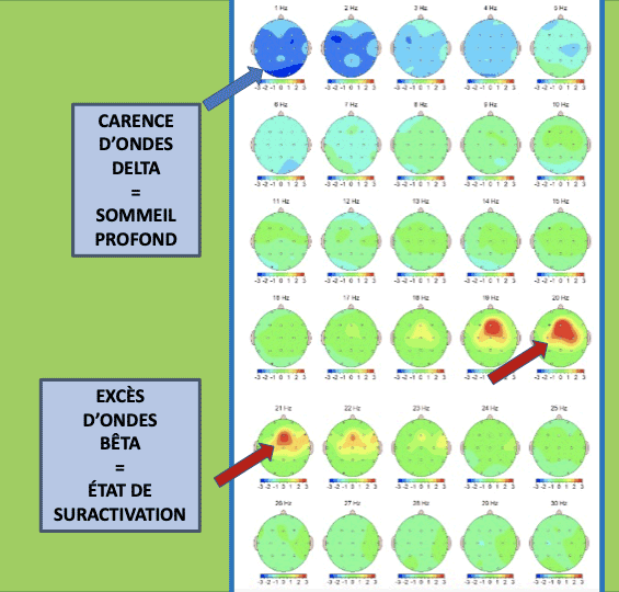005 graphique - neurofeedback EEGq TDAH et troubles du sommeil