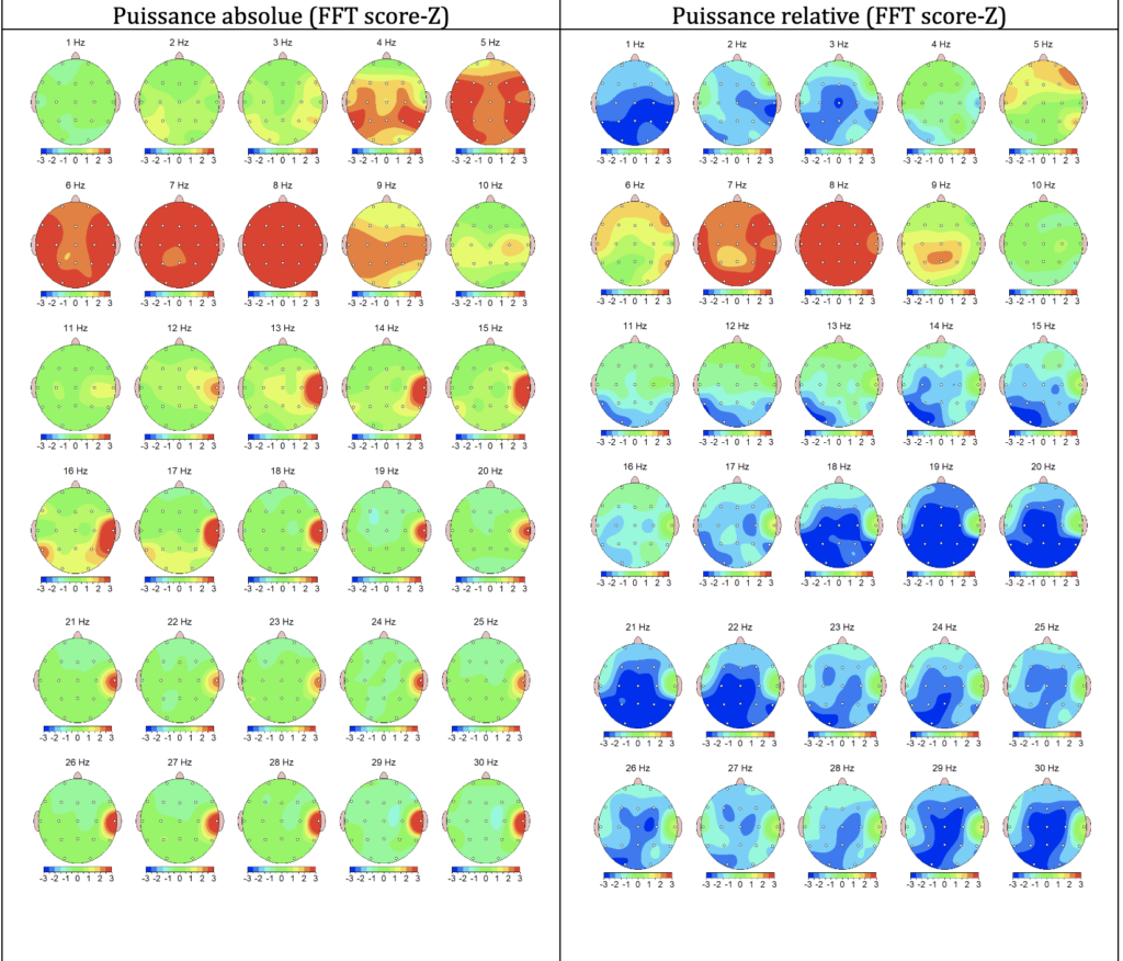 005 EEG quantitatif