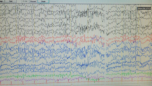Neurofeedback et régulation